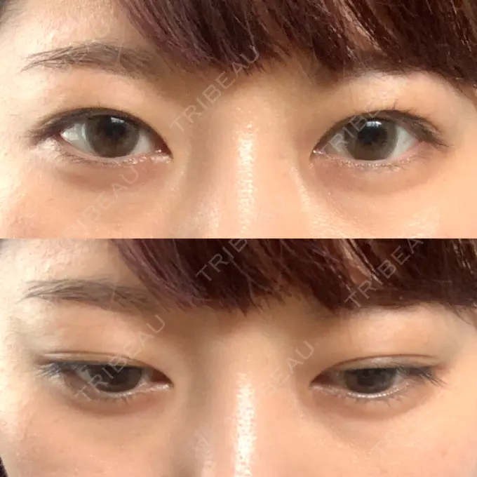 二重埋没 船橋中央クリニック DAY 38 メイン用