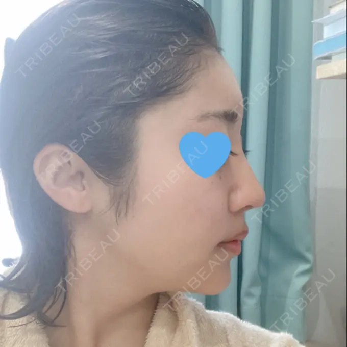 隆鼻術 / 鼻中隔延長（切開） / 軟骨移植 / ワシ鼻修正・ハンプ切除 みずほクリニック DAY 95 メイン用