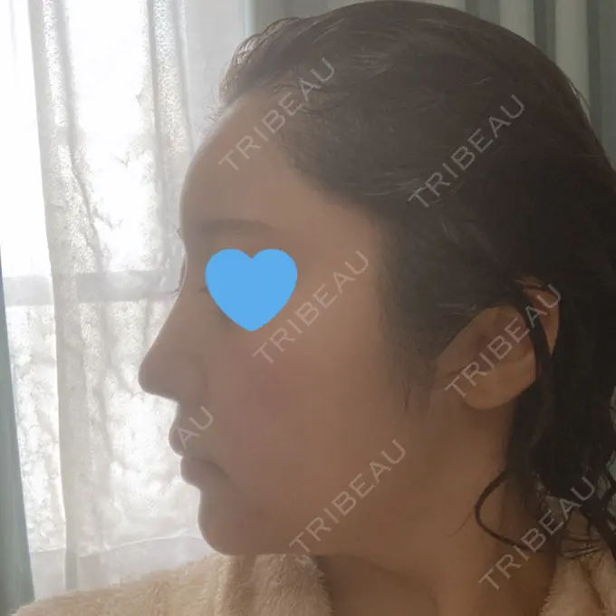 隆鼻術 / 鼻中隔延長（切開） / 軟骨移植 / ワシ鼻修正・ハンプ切除 みずほクリニック DAY 95 メイン用