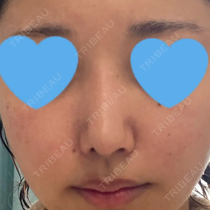 隆鼻術 / 鼻中隔延長（切開） / 軟骨移植 / ワシ鼻修正・ハンプ切除 みずほクリニック DAY 95 メイン用