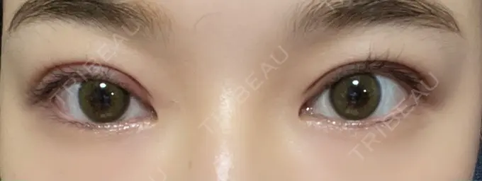 二重切開 湘南美容クリニック 藤沢院 DAY 33 メイン用