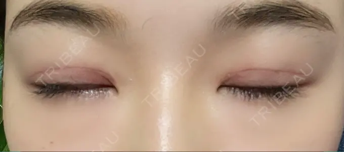 二重切開 湘南美容クリニック 藤沢院 DAY 33 メイン用