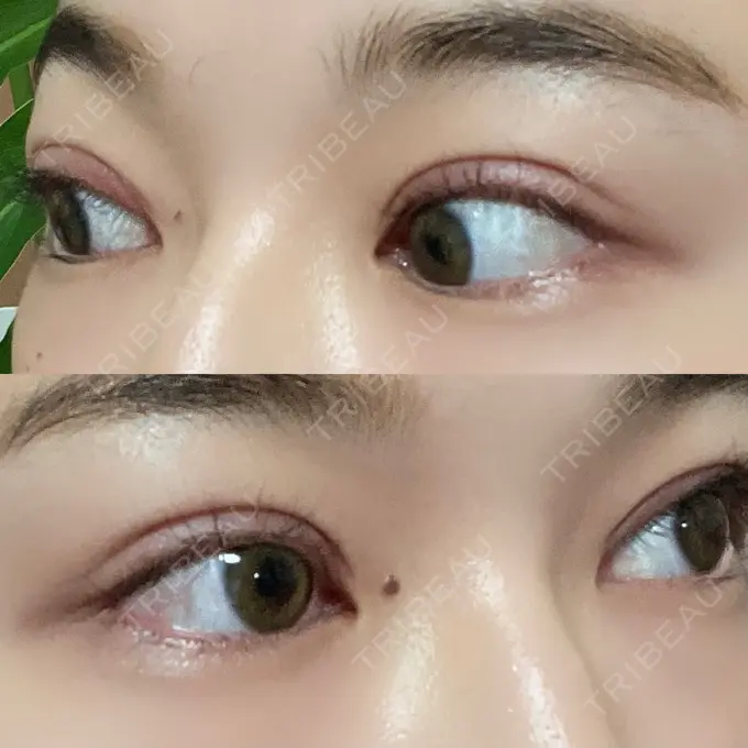 二重切開 湘南美容クリニック 藤沢院 DAY 33 メイン用