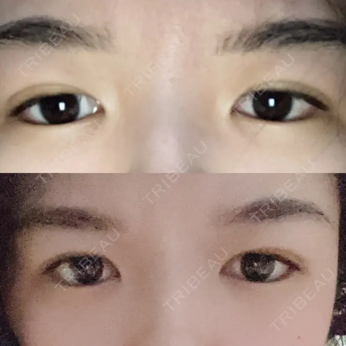 二重埋没 札幌ル・トロワ ビューティクリニックVogue DAY 6 メイン用