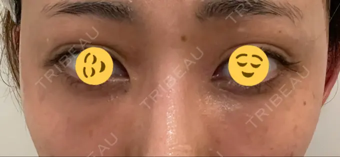 二重埋没 / クマ治療 / 上まぶたたるみ取り / 下まぶたたるみ取り MIL CLINIC OSAKA DAY 9 メイン用