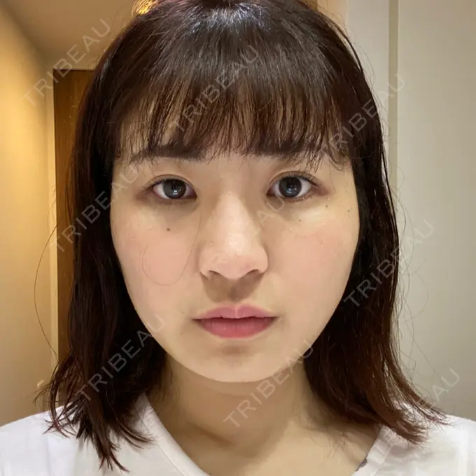 糸リフト / 脂肪吸引（顔） / その他（輪郭） TCB東京中央美容外科 八王子院 DAY 22 メイン用