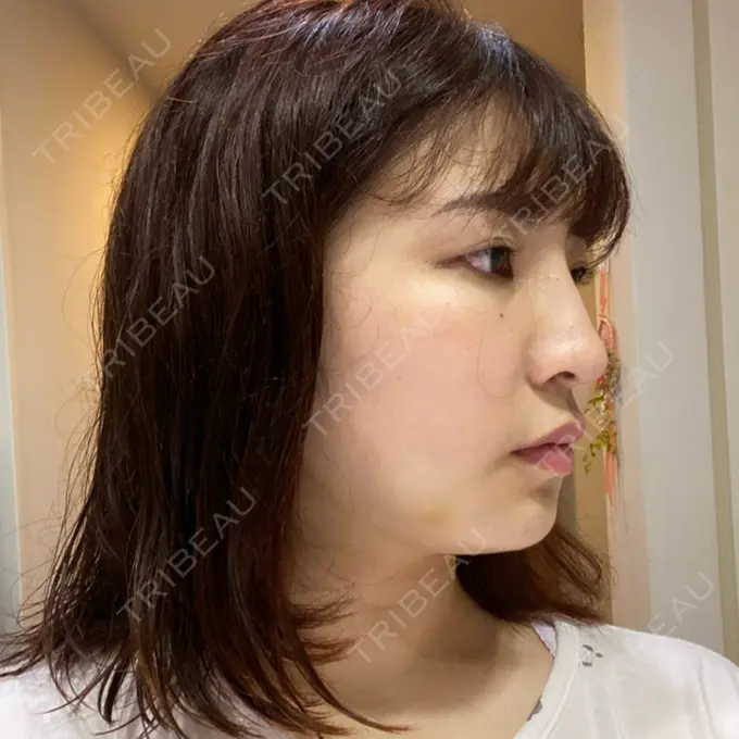 糸リフト / 脂肪吸引（顔） / その他（輪郭） TCB東京中央美容外科 八王子院 DAY 22 メイン用