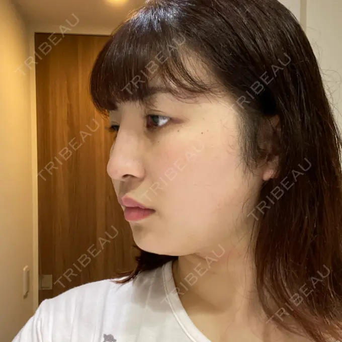 糸リフト / 脂肪吸引（顔） / その他（輪郭） TCB東京中央美容外科 八王子院 DAY 22 メイン用