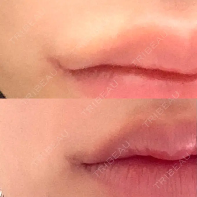 口角挙上 新宿ラクル美容外科クリニック 新宿院 AFTER メイン用