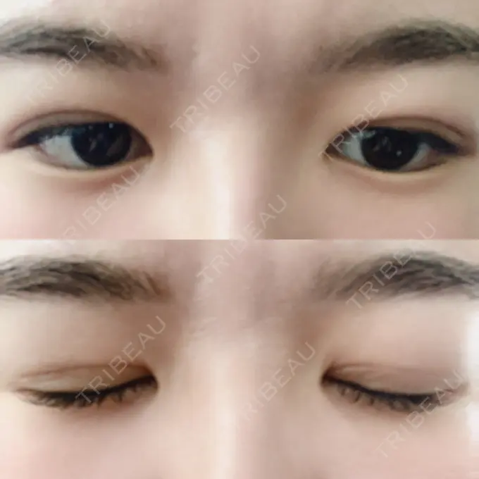 二重埋没 札幌ル・トロワ ビューティクリニックVogue AFTER メイン用