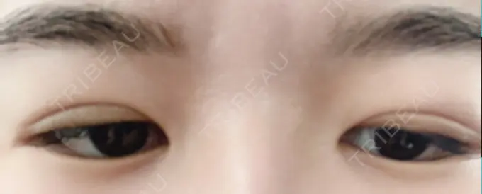 二重埋没 札幌ル・トロワ ビューティクリニックVogue DAY 8 メイン用