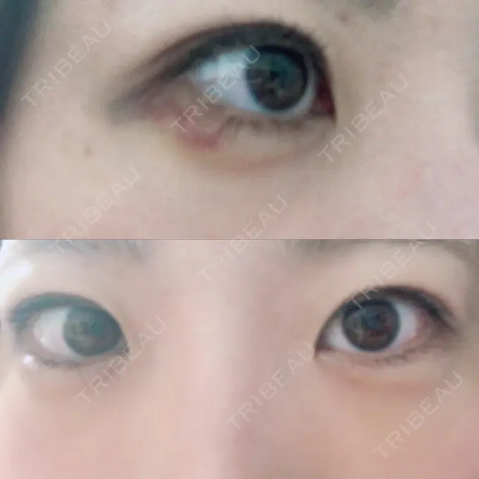 ヒアルロン酸注入（涙袋） フィラークリニック 横浜院 DAY 3 メイン用