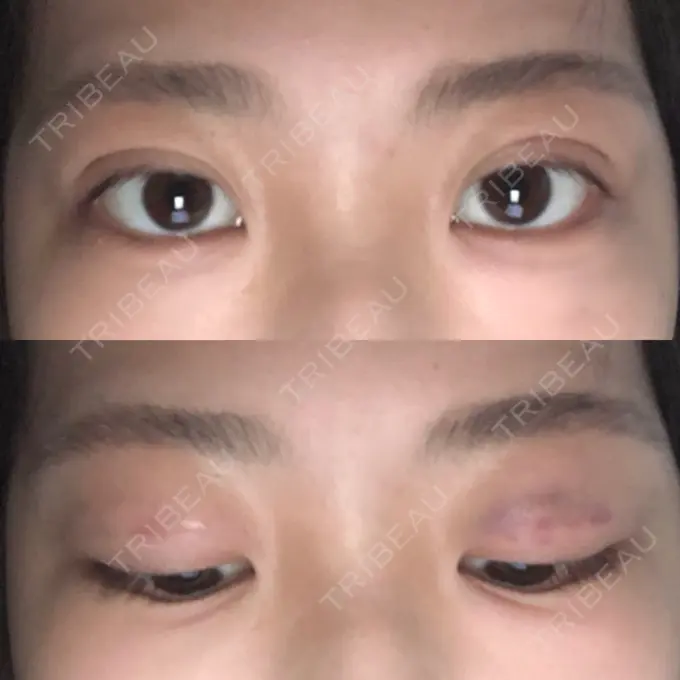 二重埋没 湘南メディカル記念病院（両国） DAY 1 メイン用