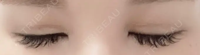 二重切開 / 蒙古ひだ形成 R.O.clinic DAY 28 メイン用