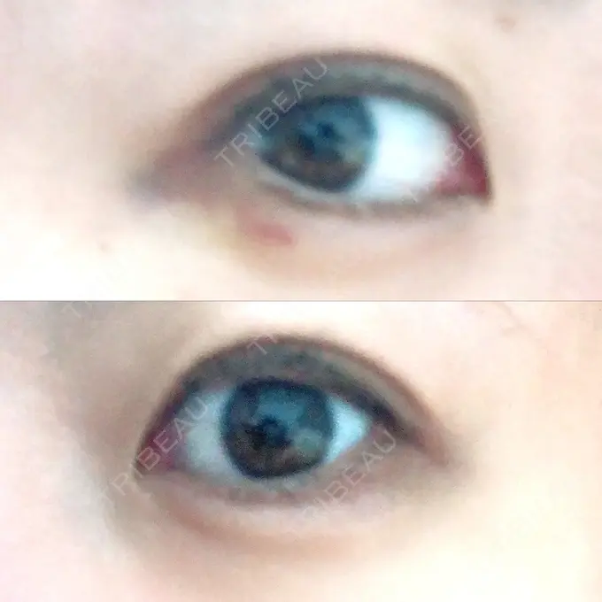 ヒアルロン酸注入（涙袋） フィラークリニック 横浜院 DAY 4 メイン用