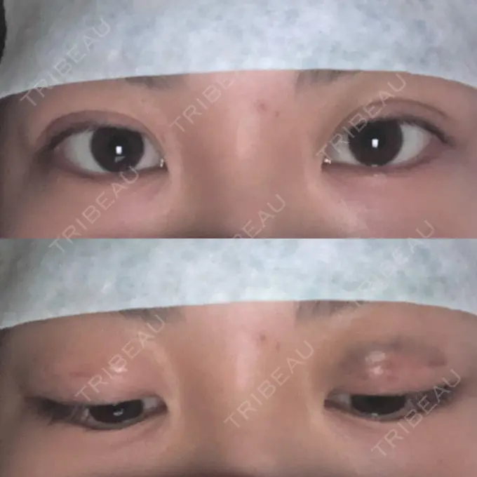 二重埋没 湘南メディカル記念病院（両国） AFTER メイン用