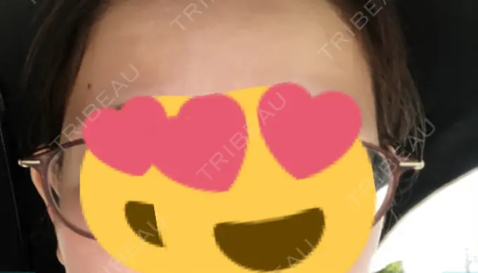 ヒアルロン酸注入（こめかみ） ルラ美容クリニック 渋谷本院 DAY 104 メイン用