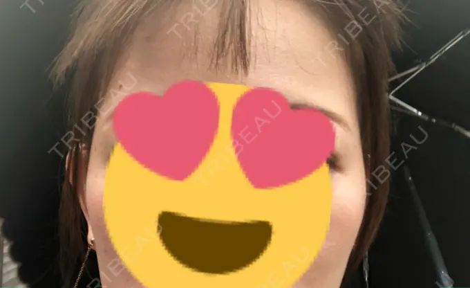 ヒアルロン酸注入（こめかみ） ルラ美容クリニック 渋谷本院 DAY 106 メイン用