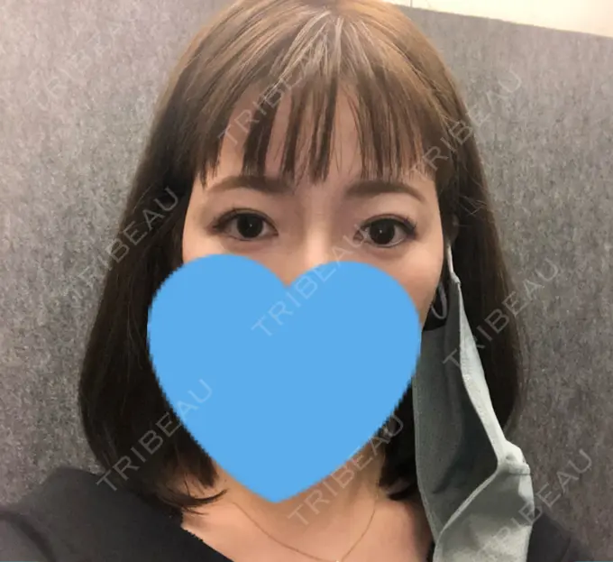 ヒアルロン酸注入（こめかみ） ルラ美容クリニック 渋谷本院 DAY 106 メイン用