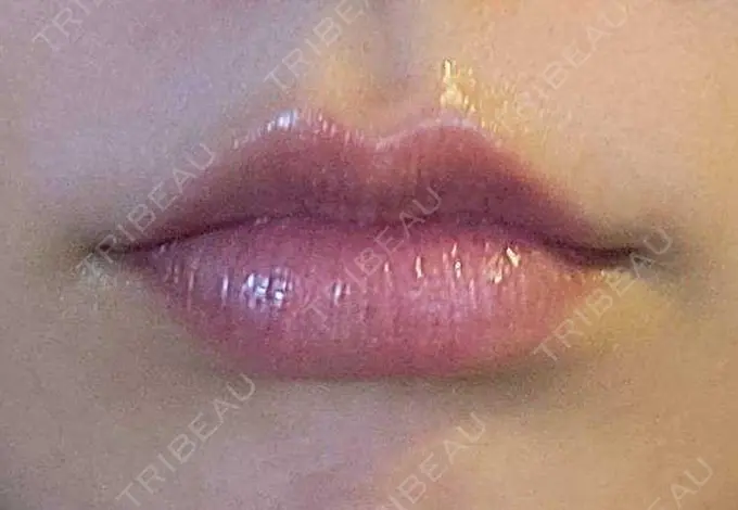 アートメイク（唇） エイトビューティークリニック 新宿院 DAY 5 メイン用