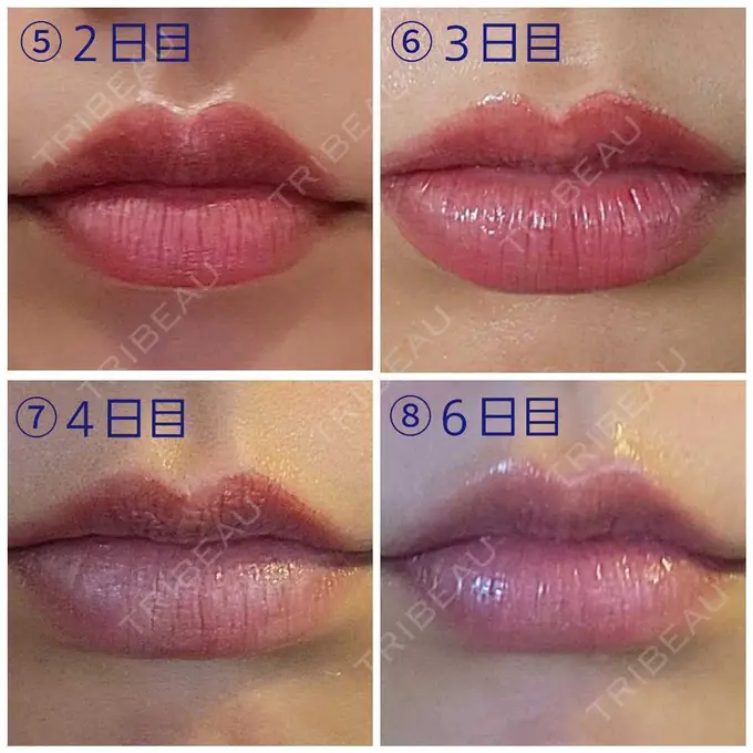アートメイク（唇） エイトビューティークリニック 新宿院 DAY 5 メイン用