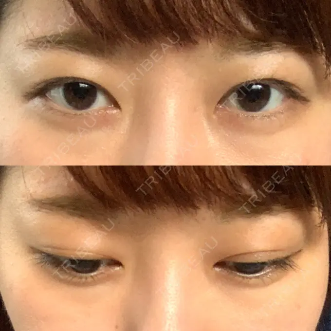 二重埋没 船橋中央クリニック DAY 45 メイン用