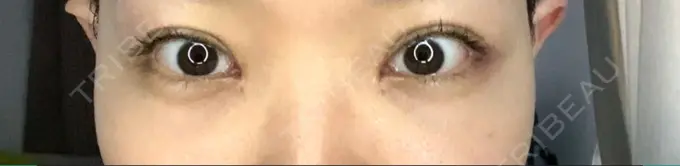 二重切開 / 目頭切開 心斎橋コムロ美容外科クリニック AFTER メイン用