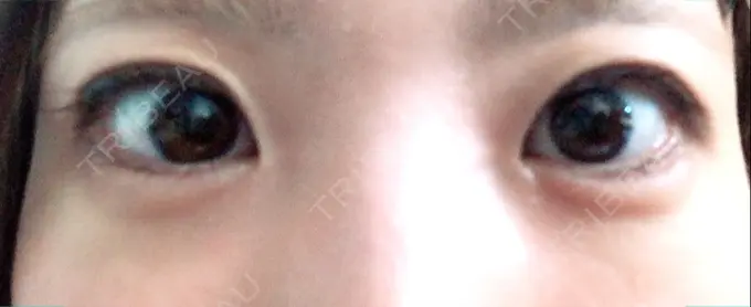 ヒアルロン酸注入（涙袋） フィラークリニック 横浜院 DAY 7 メイン用