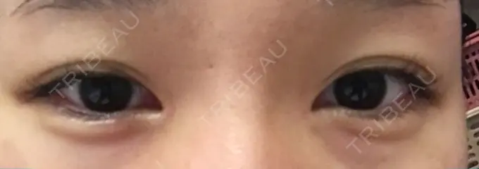 ヒアルロン酸注入（涙袋） フィラークリニック 横浜院 AFTER メイン用