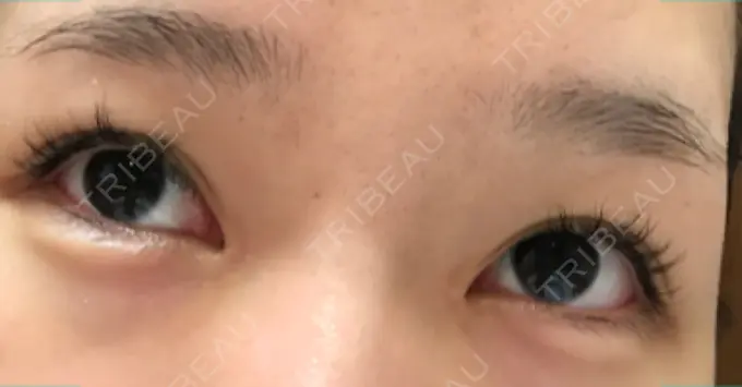 ヒアルロン酸注入（涙袋） フィラークリニック 横浜院 DAY 137 メイン用