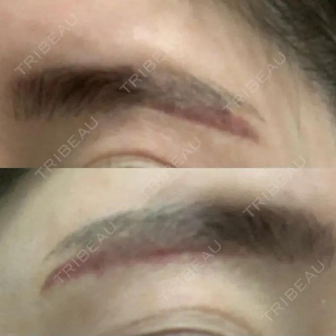 その他（目元） / その他 / 傷跡修正 名古屋中央クリニック DAY 3 メイン用