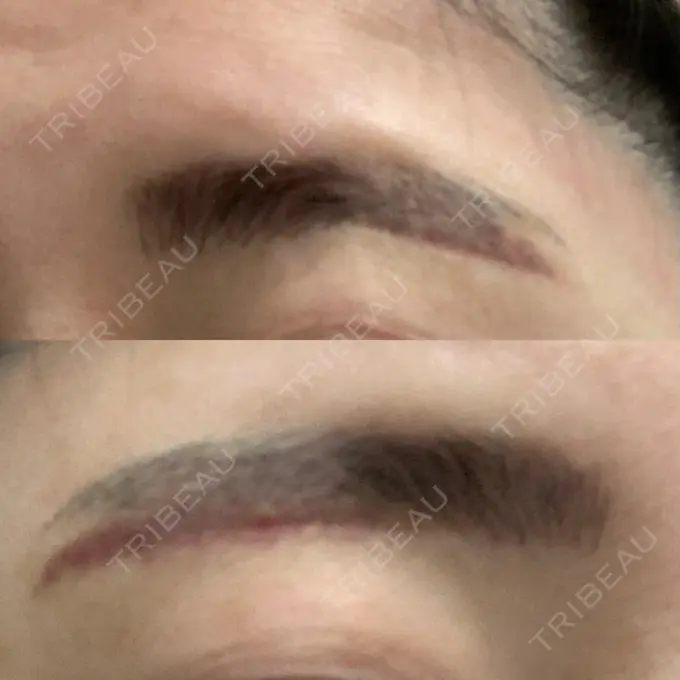 その他（目元） / その他 / 傷跡修正 名古屋中央クリニック DAY 4 メイン用