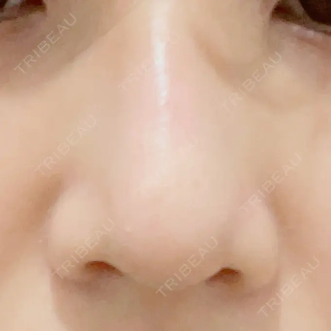 鼻尖形成（切開） / ヒアルロン酸注入（鼻） 東京ヒルズクリニック 岡崎院 DAY 7 メイン用