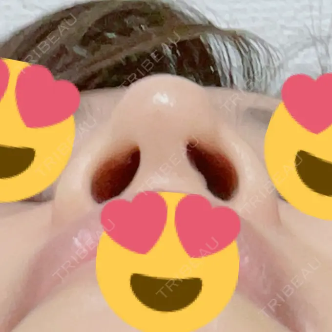 鼻尖形成（切開） / ヒアルロン酸注入（鼻） 東京ヒルズクリニック 岡崎院 DAY 7 メイン用