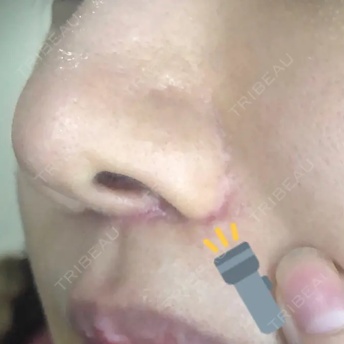 人中短縮 みずほクリニック DAY 57 メイン用