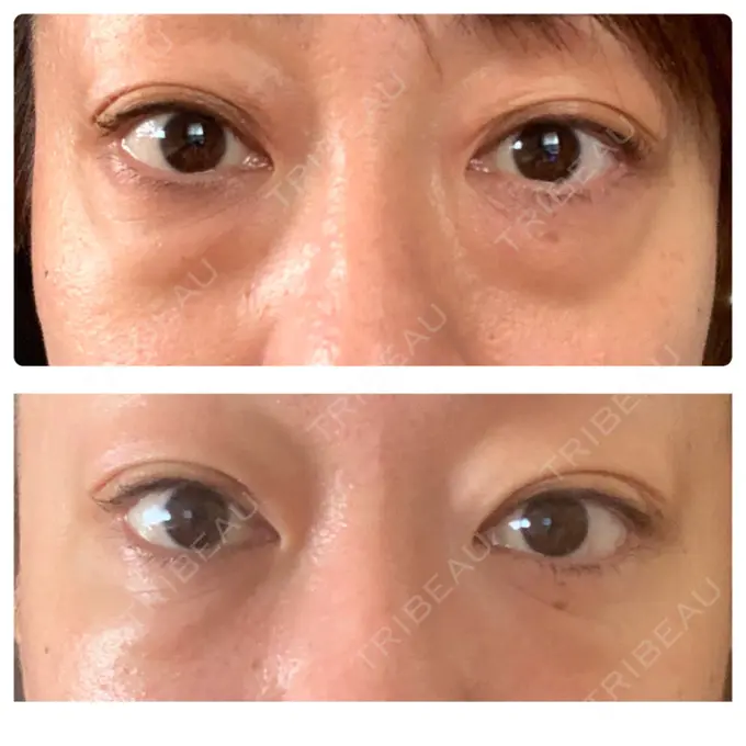 下まぶたたるみ取り / 下まぶたの脂肪取り セオリークリニック DAY 92 メイン用