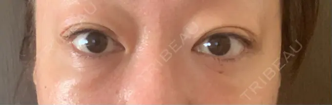 下まぶたたるみ取り / 下まぶたの脂肪取り セオリークリニック DAY 92 メイン用