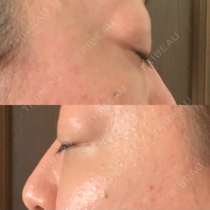 下まぶたたるみ取り / 下まぶたの脂肪取り セオリークリニック DAY 92 メイン用