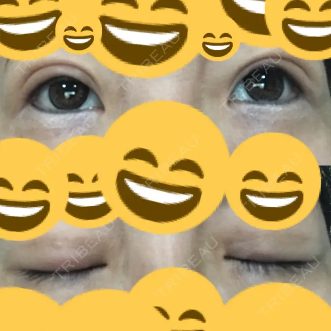 二重埋没 神戸元町ビューティークリニック DAY 62 メイン用