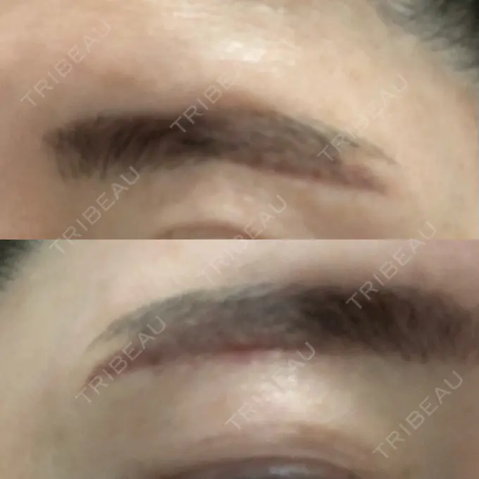 その他（目元） / その他 / 傷跡修正 名古屋中央クリニック DAY 5 メイン用