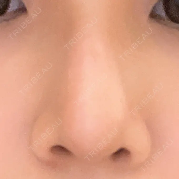 鼻尖形成（切開） / ヒアルロン酸注入（鼻） 東京ヒルズクリニック 岡崎院 DAY 8 メイン用