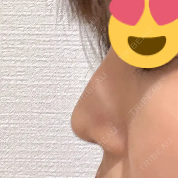 鼻尖形成（切開） / ヒアルロン酸注入（鼻） 東京ヒルズクリニック 岡崎院 DAY 8 メイン用