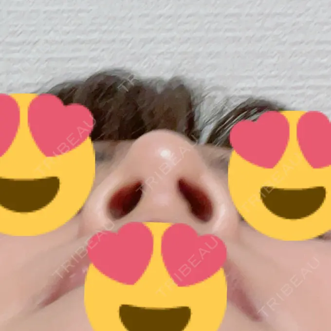 鼻尖形成（切開） / ヒアルロン酸注入（鼻） 東京ヒルズクリニック 岡崎院 DAY 8 メイン用