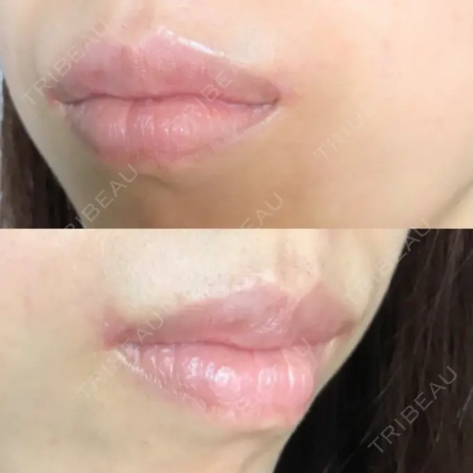 口角挙上 / その他（口元） eクリニック 金沢本院 DAY 250 メイン用