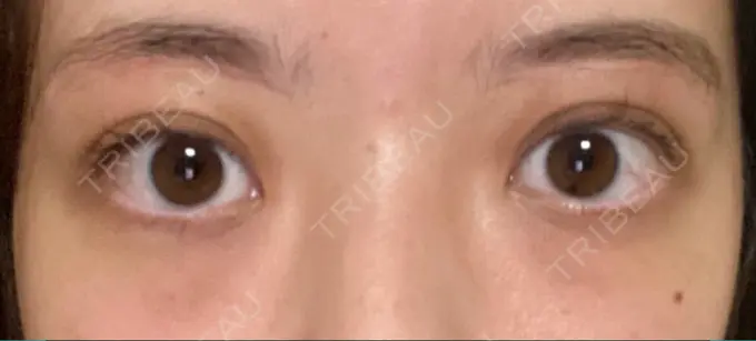 眉下切開 Taide Suenaga Clinic（タイデスエナガクリニック） DAY 197 メイン用