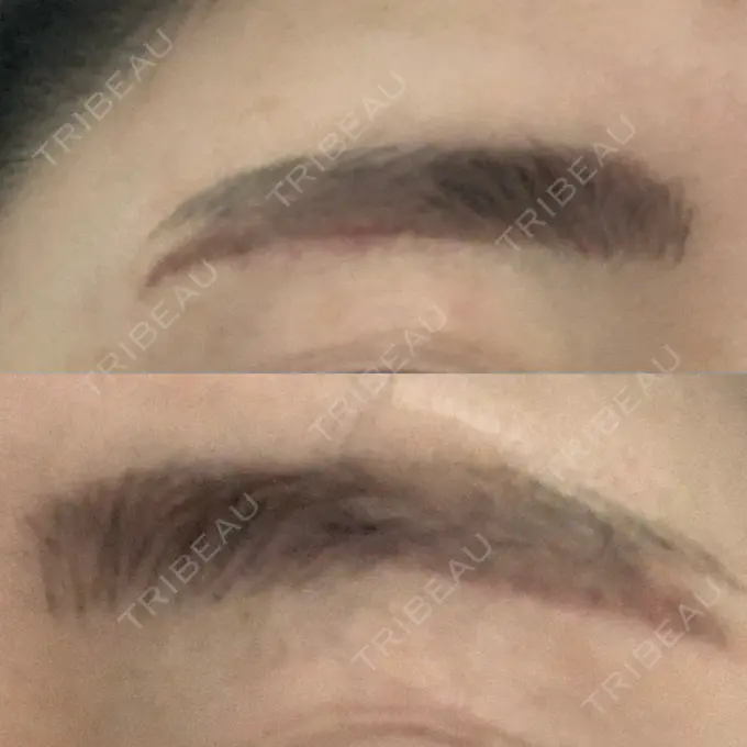 その他（目元） / その他 / 傷跡修正 名古屋中央クリニック DAY 6 メイン用