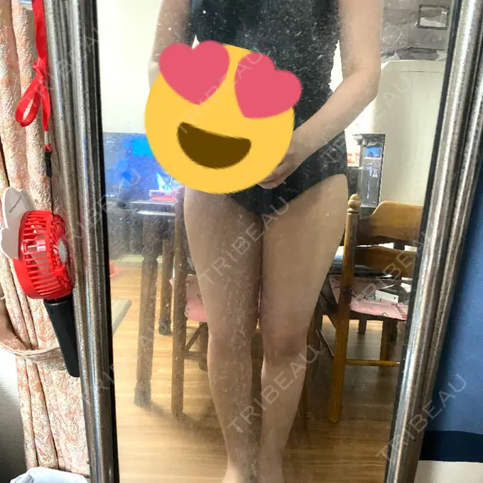 脂肪吸引（脚） THE CLINIC（ザ・クリニック） 名古屋院 DAY 12 メイン用