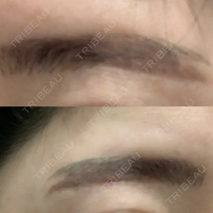 その他（目元） / その他 / 傷跡修正 名古屋中央クリニック DAY 7 メイン用