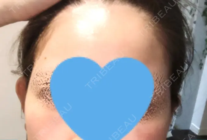 ヒアルロン酸注入（こめかみ） ルラ美容クリニック 渋谷本院 DAY 113 メイン用