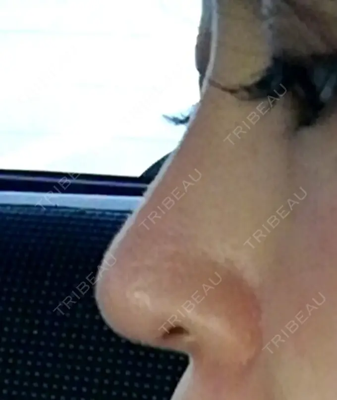 隆鼻術 / 鼻尖形成（切開） / 軟骨移植 ヤスミクリニック AFTER メイン用